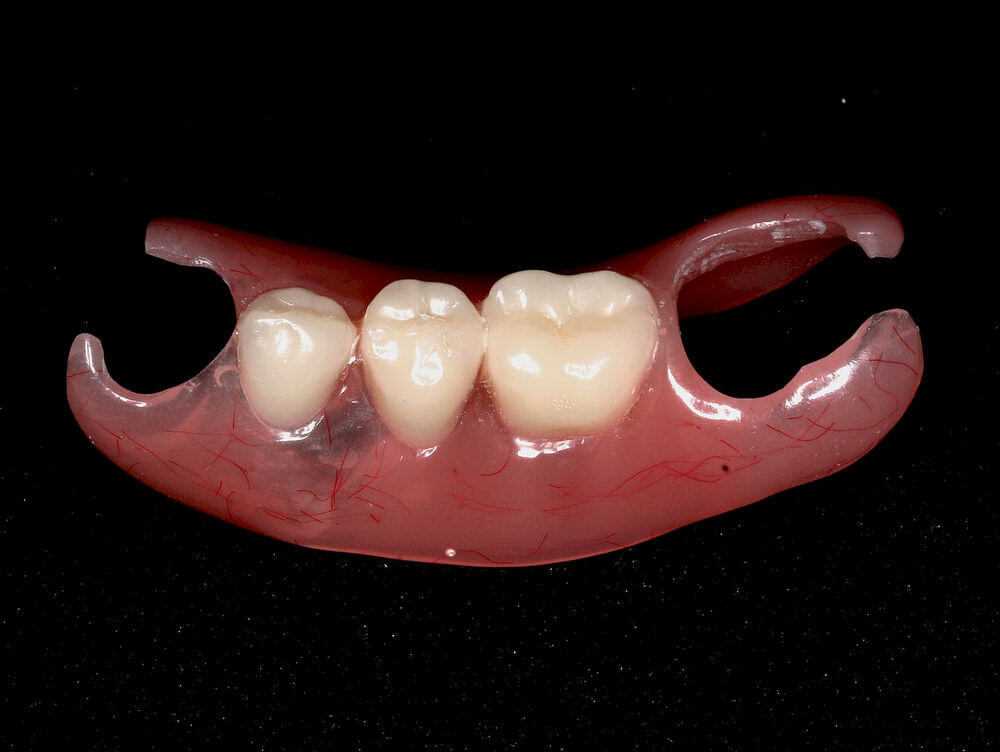 Протезирование нижних зубов - фото до и после
