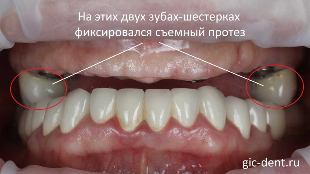 При разрушении или отсутствии 1 зуба
