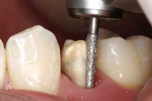 Протезирование зубов обточка — эффективное решение для восстановления улыбки и улучшения качества жизни