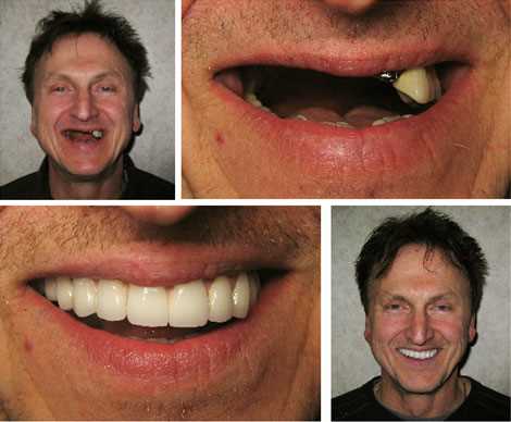Виды протезирования зубов