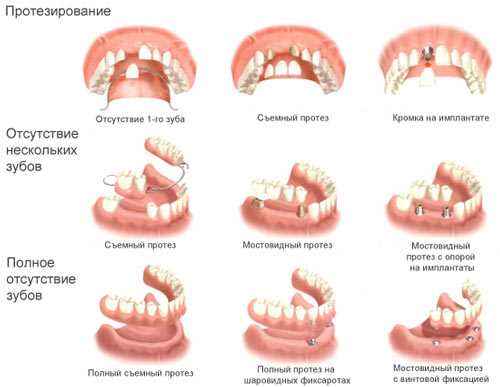 Плюсы и минусы различных видов зубного протезирования