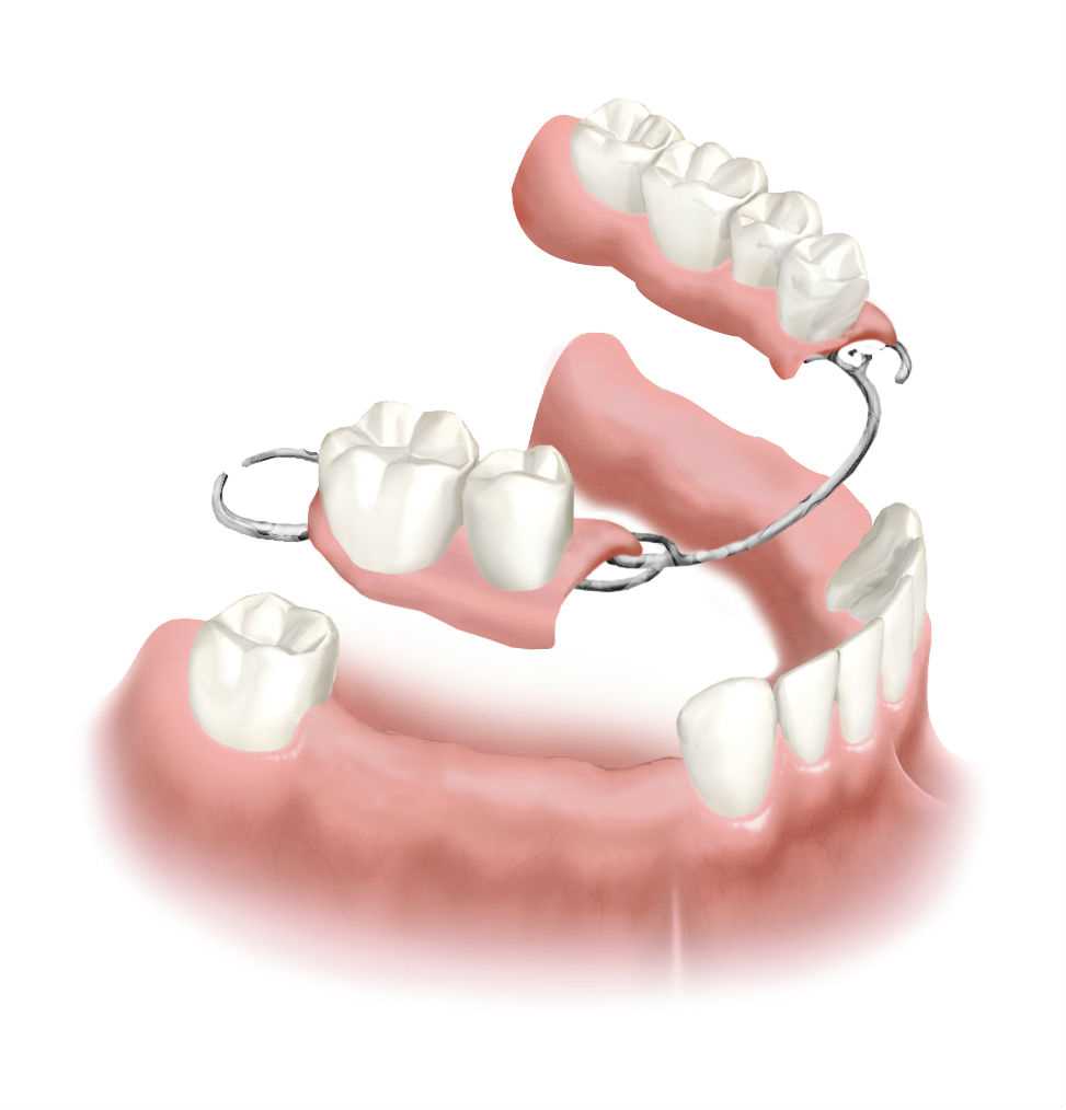Показания, противопоказания и этапы съемного протезирования зубов