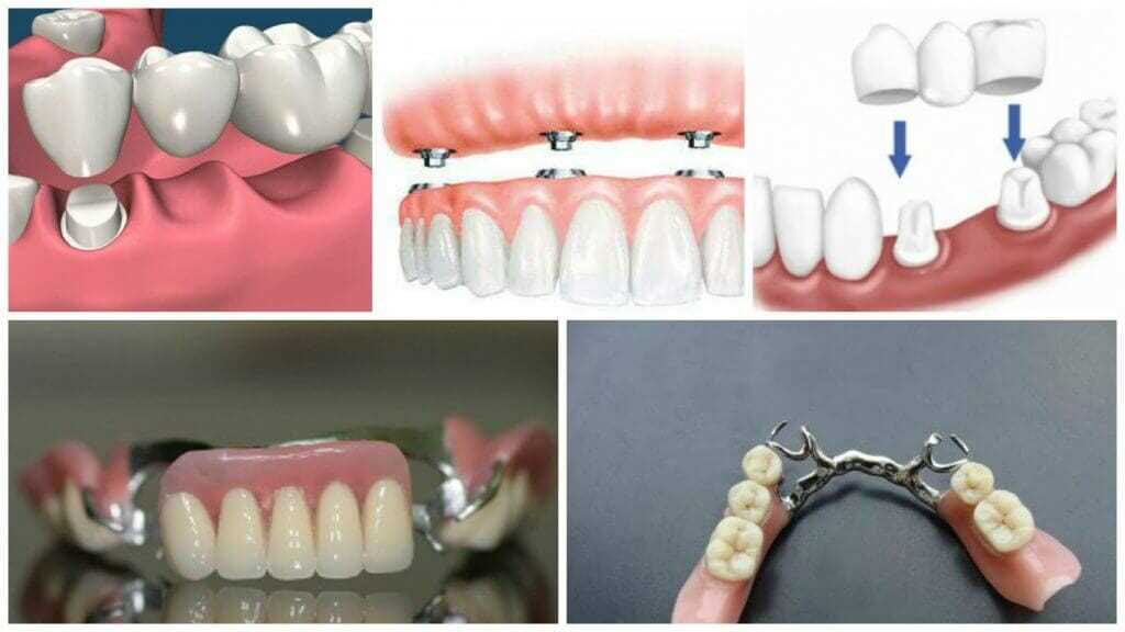 Показания к зубному протезированию съемными протезами