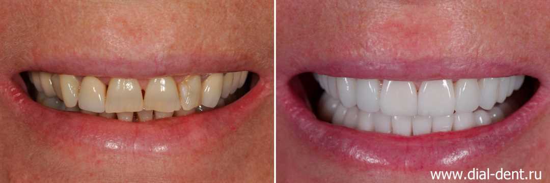 Протезирование зубов при пародонтите