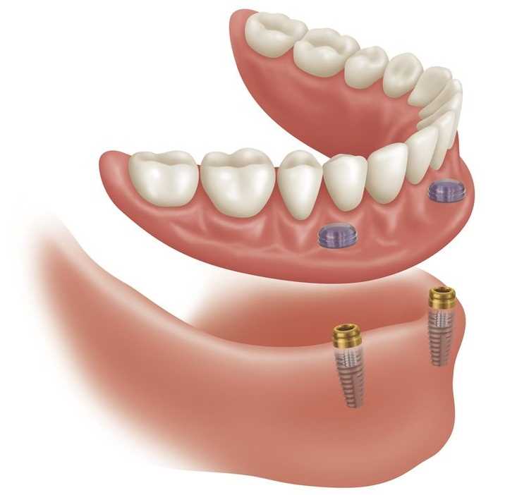 Несъемное зубное протезирование