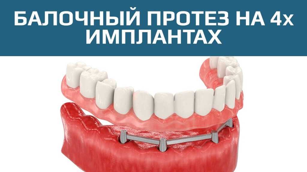 Протезирование зубов рядом — инновационные методы и технологии в стоматологии для восстановления улыбки и функциональности