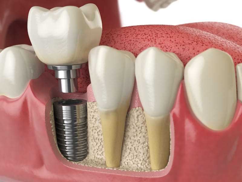 Протезирование зубов стоматология 1