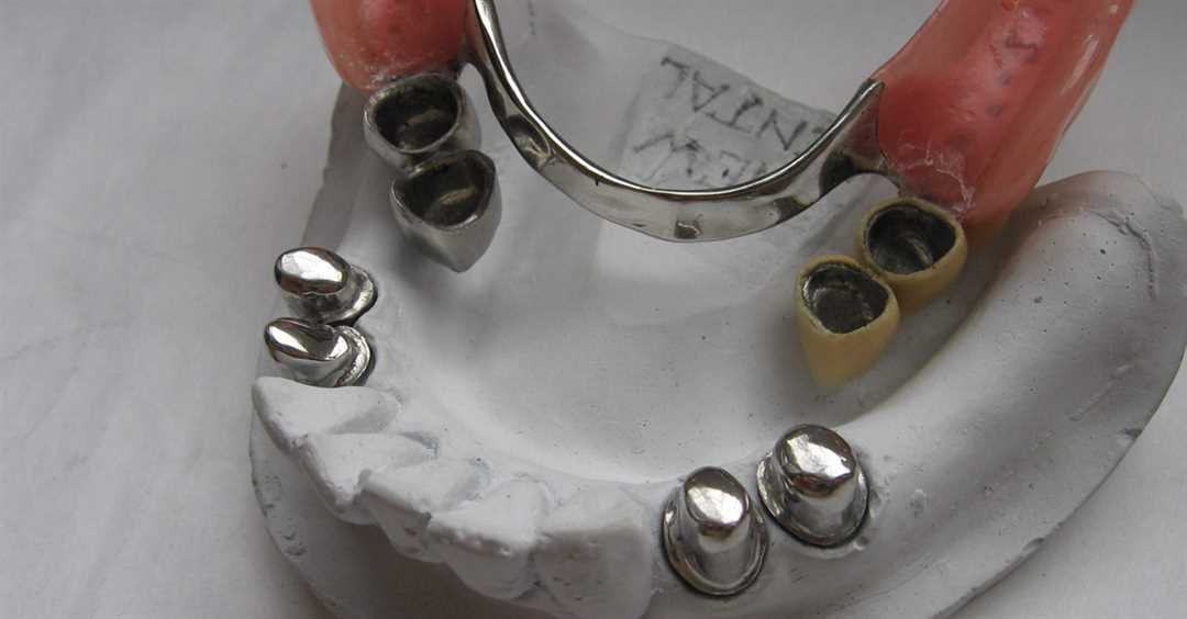Этапы изготовления телескопического зубного протеза