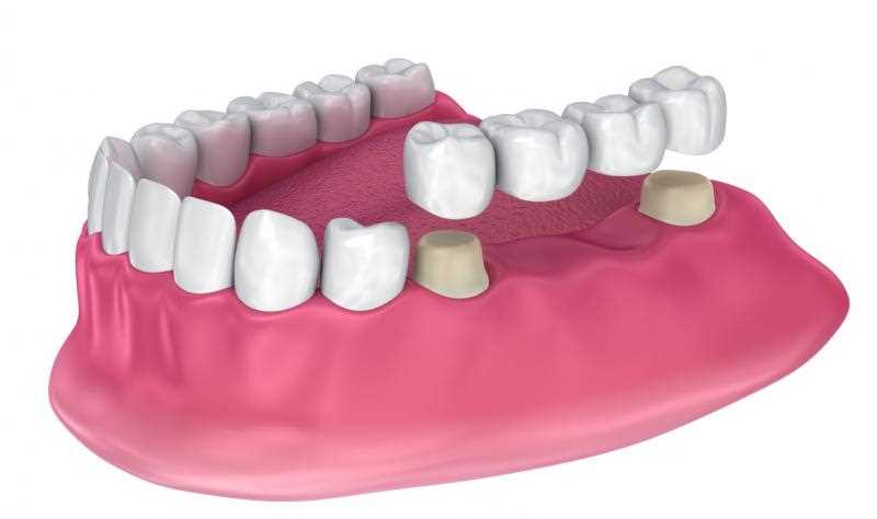 Протезирование зубов в башкирии