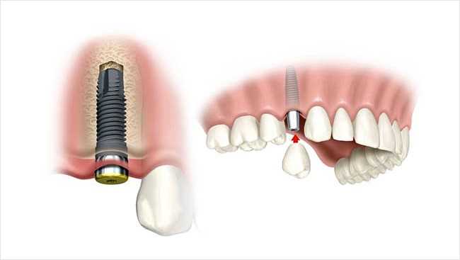 Преимущества имплантации зубов all-on-4: