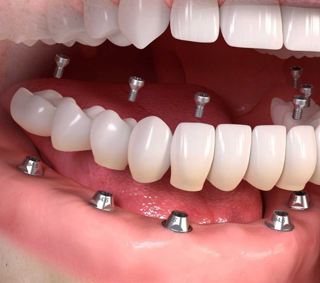 Протезирование всех зубов рта — преимущества, виды протезов, этапы процедуры