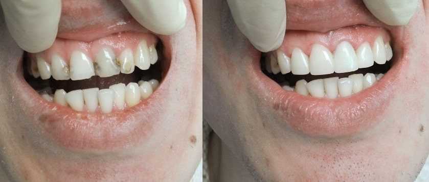Как восстанавливают зубы вкладками