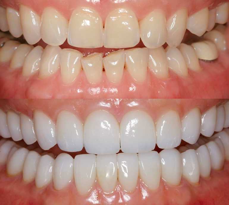 Протезирование зубов восстановление