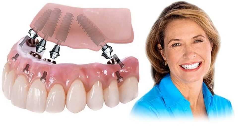 Протезирование зубов — возможности и перспективы современной медицины