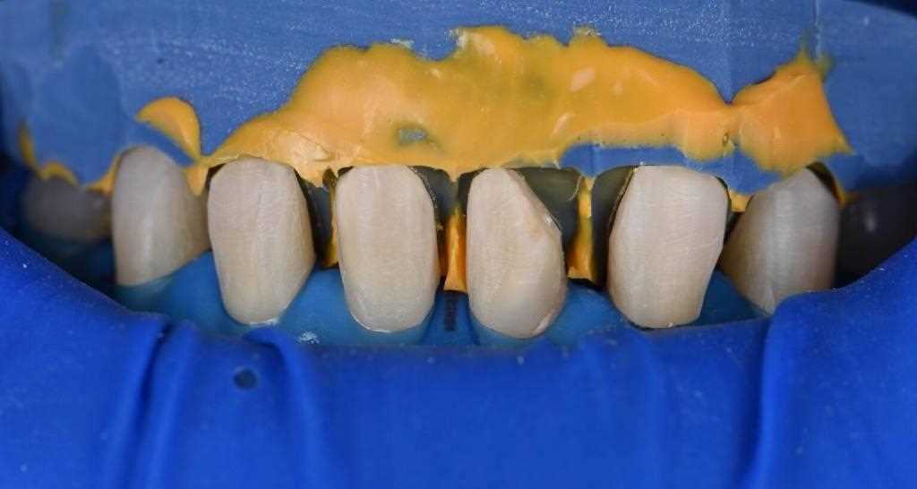 Протокол препарирования зубов под реставрацию. Подготовка к реставрации. Методы изготовления силиконовых ключей
