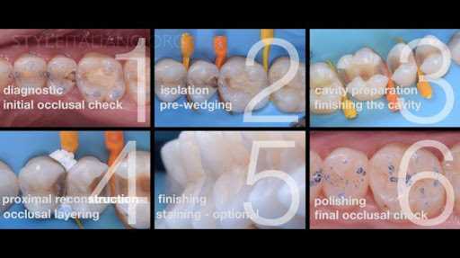 Художественная реставрация зуба 3.6 пошаговый протокол