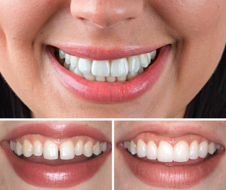 Что нужно знать о реставрации зубов?