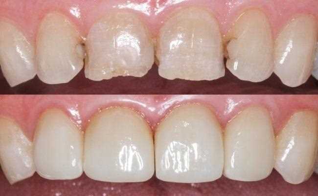 Прямая и непрямая реставрация зубов в чем отличие?