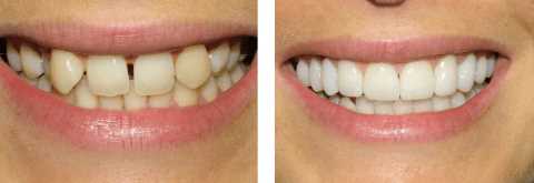 Прямая или композитная реставрация зубов