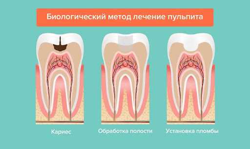 Методы и препараты для лечения пульпита зубов — основные принципы и эффективность