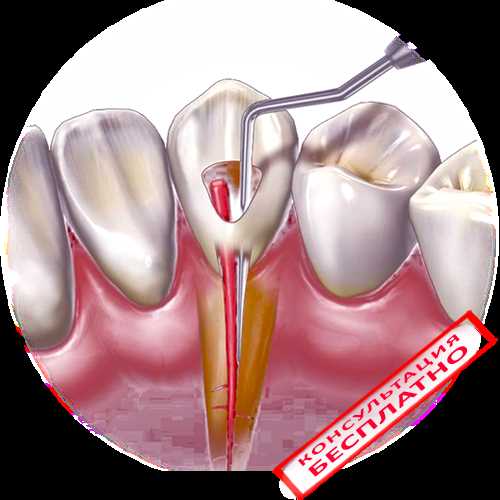 Пульпит переднего зуба лечение