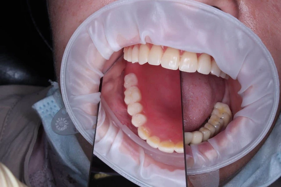 Преимущества установки зубных протезов