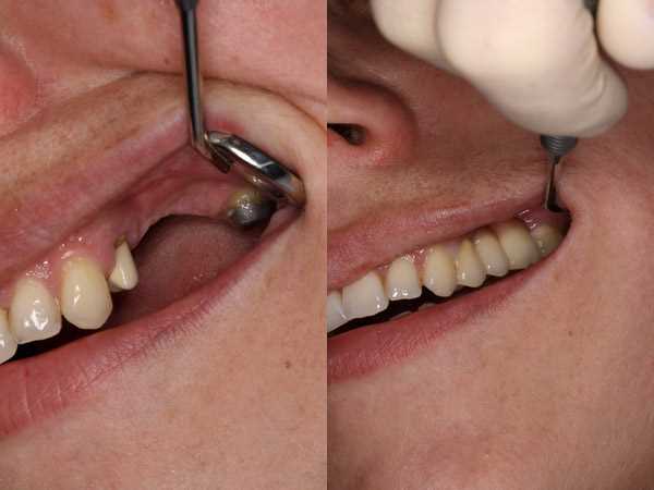 Протезирование зубов — от фиксации стоячего на месте и восстановления функциональности до эстетической гармонии