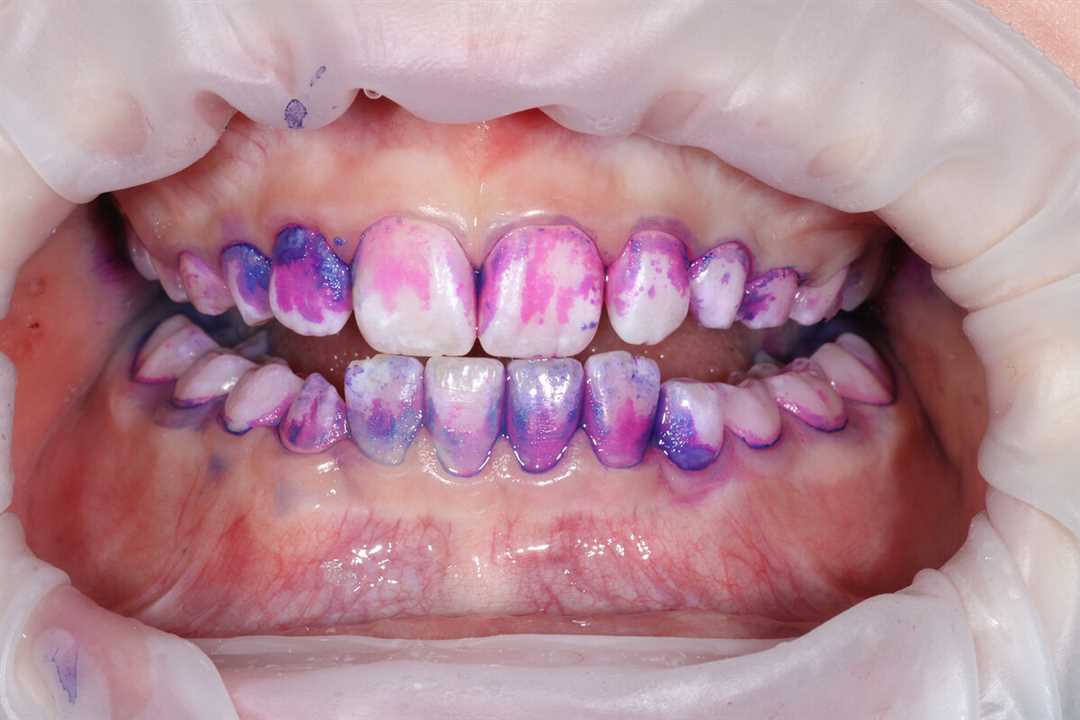Растворы для окрашивания зубного налета