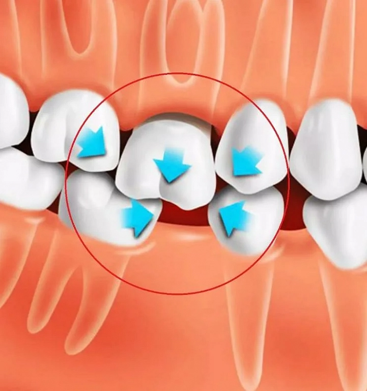 Рекомендации удаления зуба взрослому