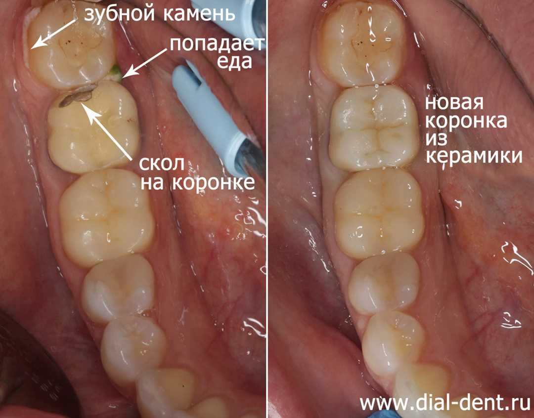 Реставрация зубных коронок