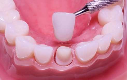 Ремонт коронок зубных — как вернуть улыбку без больших затрат и сложностей