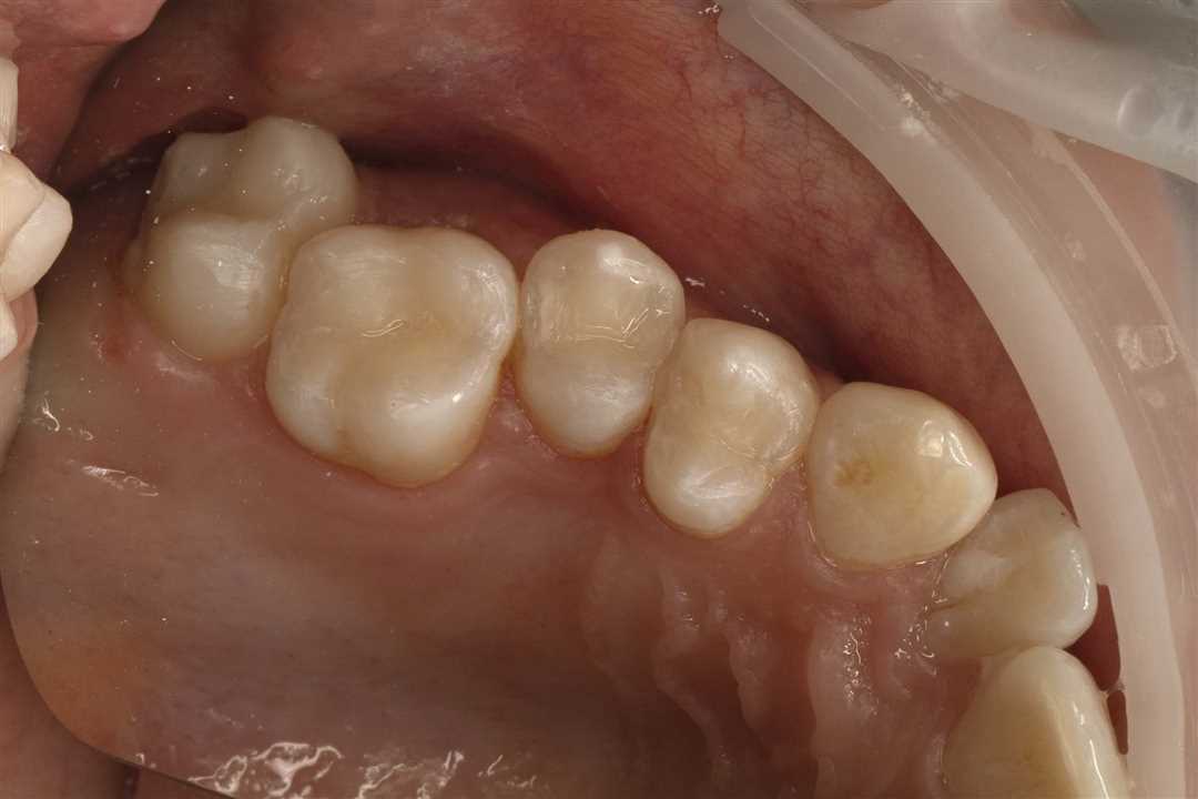 Реставрация передних зубов