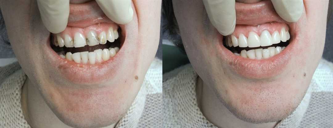Процедура реставрации 15 зубов — все, что вам нужно знать о сохранении здоровья вашей улыбки