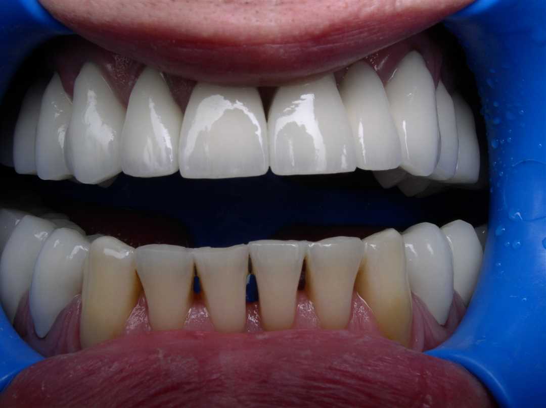 В каких случаях необходима реставрация зуба?
