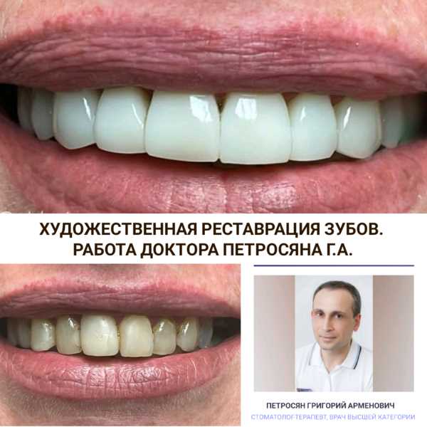 Подробная реставрация 24 зубов — от восстановления эстетики и функциональности до полного оздоровления полости рта без хирургического вмешательства
