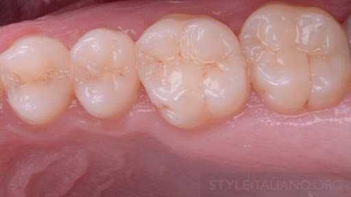 Восстановление функции и эстетики усилено 26 зубами
