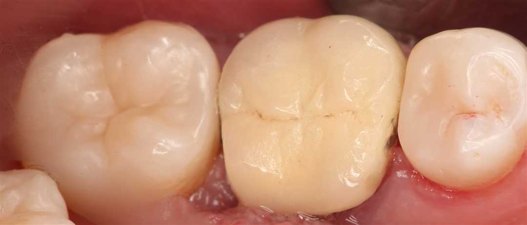 Что такое эстетическая реставрация зубов?