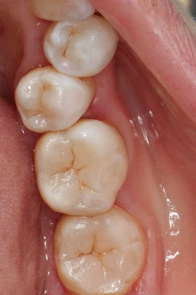 Реставрация 35 зуба