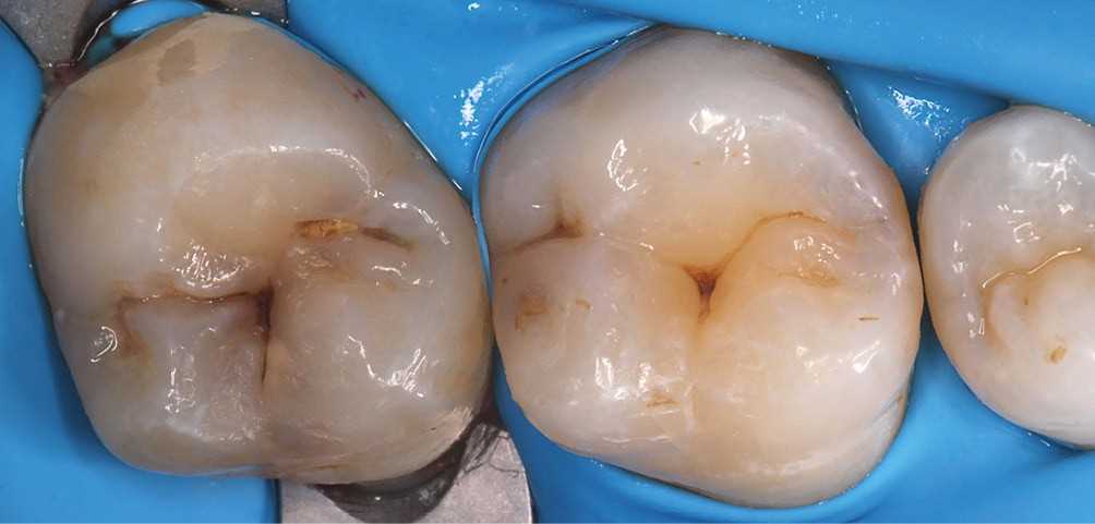 Реставрация 46 зуба по силиконовому ключу