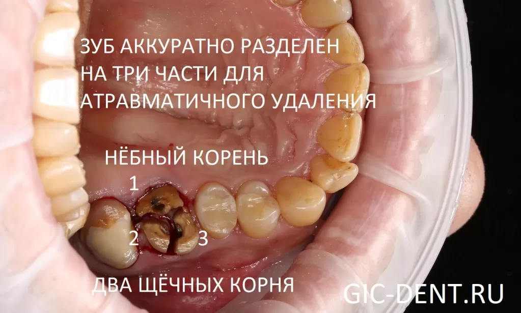 Почему такой зуб нужно покрыть коронкой?