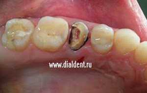 Реставрация депульпированного зуба