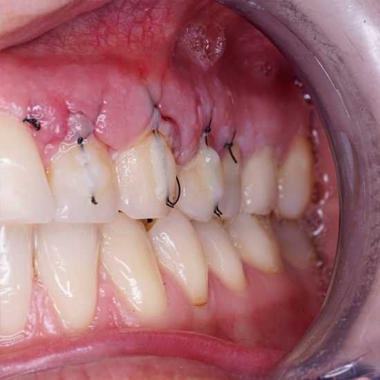 Все, что вам нужно знать о реставрации десны над зубом — причины, методы и последствия