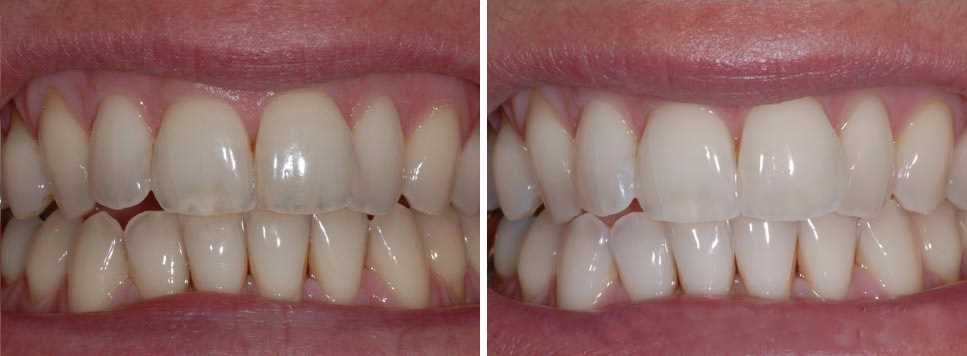 Симптомы разрушения зубной эмали
