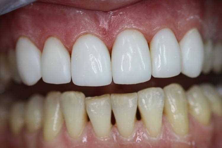 Частые проблемы эмали зубов