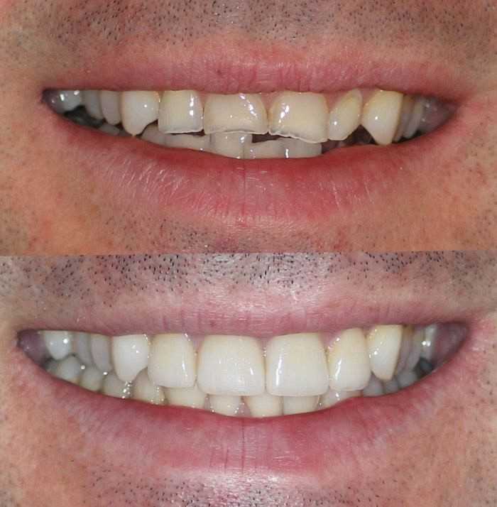 Реставрация эмали зубов