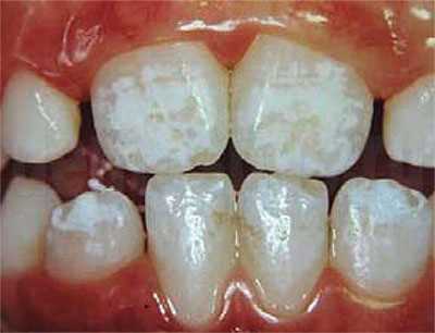 Лечение эрозии эмали зубов в клинике