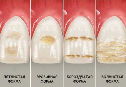 Как вернуть здоровье и красоту зубам — эффективные методы реставрации эрозии и пути их предотвращения
