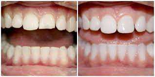 Реставрация и отбеливание зубов