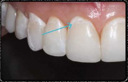 Стадии развития клиновидного дефекта зуба
