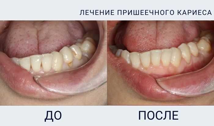 Реставрация клиновидного дефекта зуба